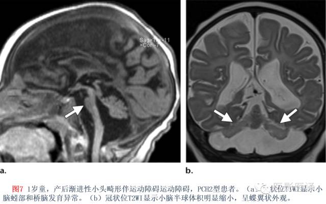 后颅窝先天性异常的影像学表现 后颅窝先天性异常的影像学表现