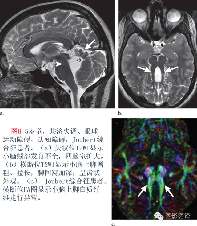 后颅窝先天性异常的影像学表现 后颅窝先天性异常的影像学表现