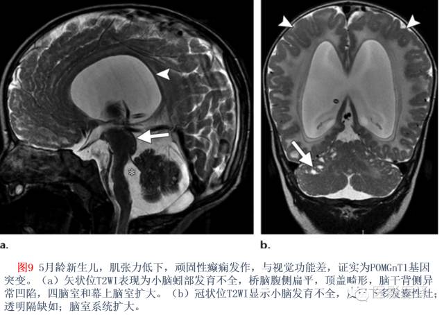 后颅窝先天性异常的影像学表现 后颅窝先天性异常的影像学表现