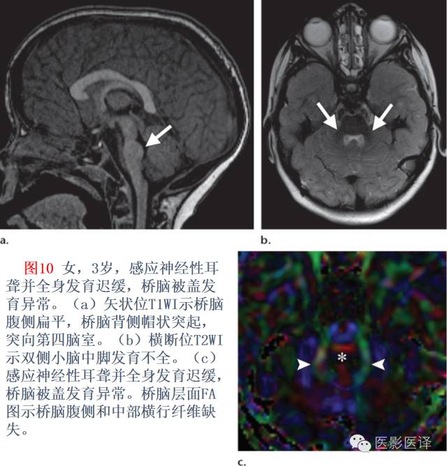 后颅窝先天性异常的影像学表现 后颅窝先天性异常的影像学表现
