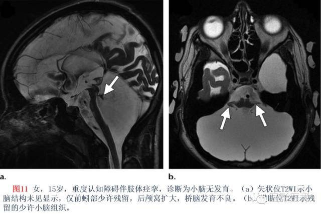 后颅窝先天性异常的影像学表现 后颅窝先天性异常的影像学表现