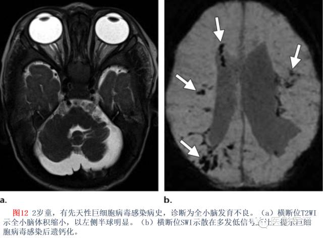 后颅窝先天性异常的影像学表现 后颅窝先天性异常的影像学表现