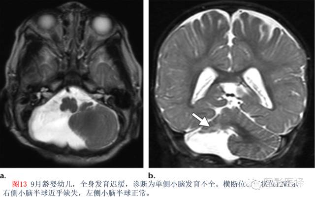 后颅窝先天性异常的影像学表现 后颅窝先天性异常的影像学表现