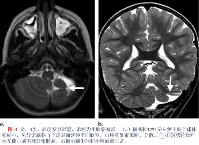 后颅窝先天性异常的影像学表现 后颅窝先天性异常的影像学表现
