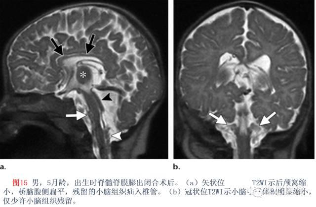 后颅窝先天性异常的影像学表现 后颅窝先天性异常的影像学表现