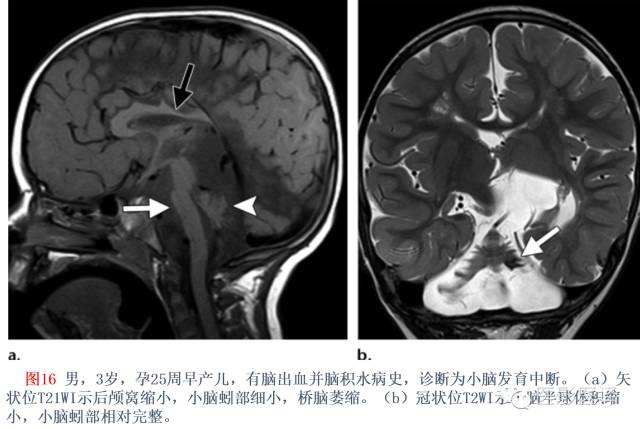 后颅窝先天性异常的影像学表现 后颅窝先天性异常的影像学表现