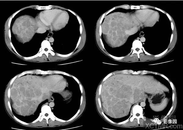 【病例】原发性肝癌1例CT影像表现 【病例】原发性肝癌1例CT影像表现