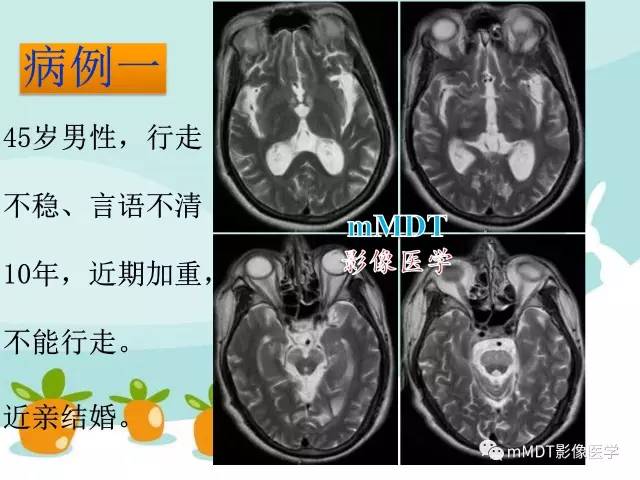 【PPT】脑腱黄瘤病