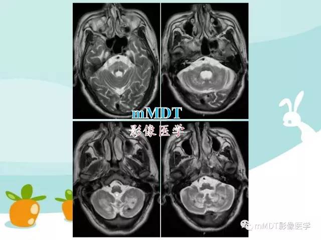 【PPT】脑腱黄瘤病