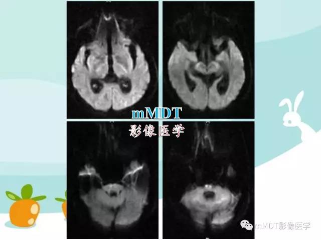 【PPT】脑腱黄瘤病