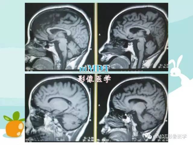 【PPT】脑腱黄瘤病