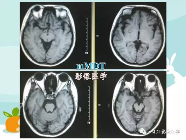 【PPT】脑腱黄瘤病
