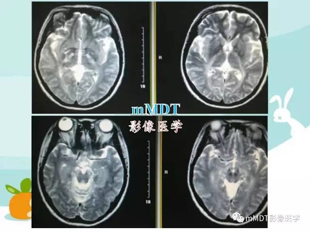【PPT】脑腱黄瘤病