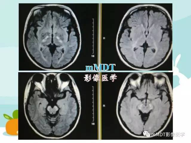 【PPT】脑腱黄瘤病