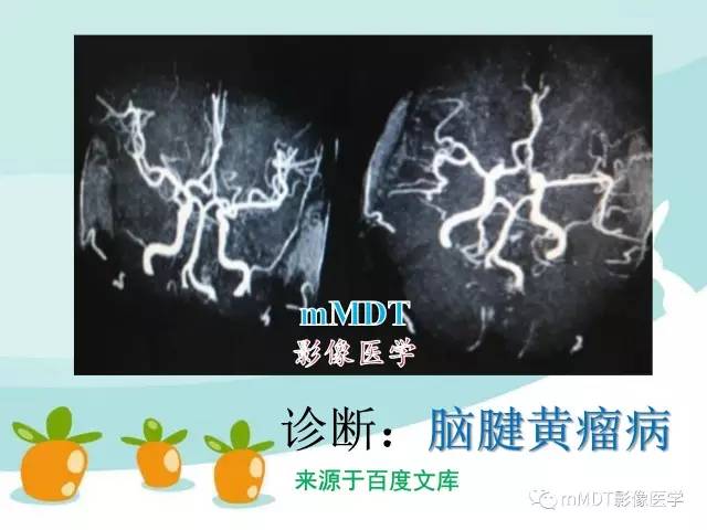 【PPT】脑腱黄瘤病
