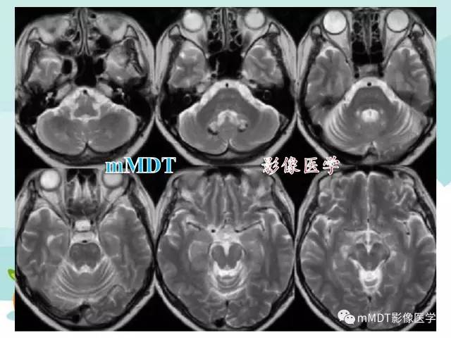 【PPT】脑腱黄瘤病