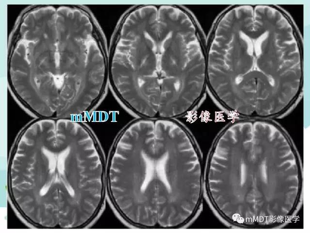 【PPT】脑腱黄瘤病