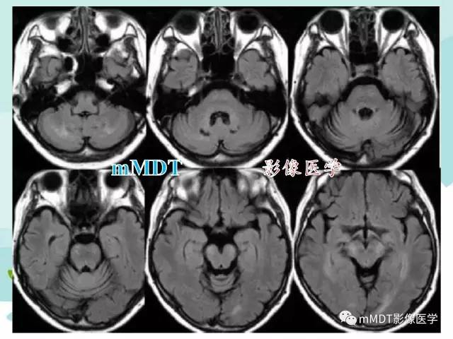 【PPT】脑腱黄瘤病