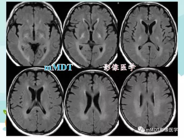 【PPT】脑腱黄瘤病