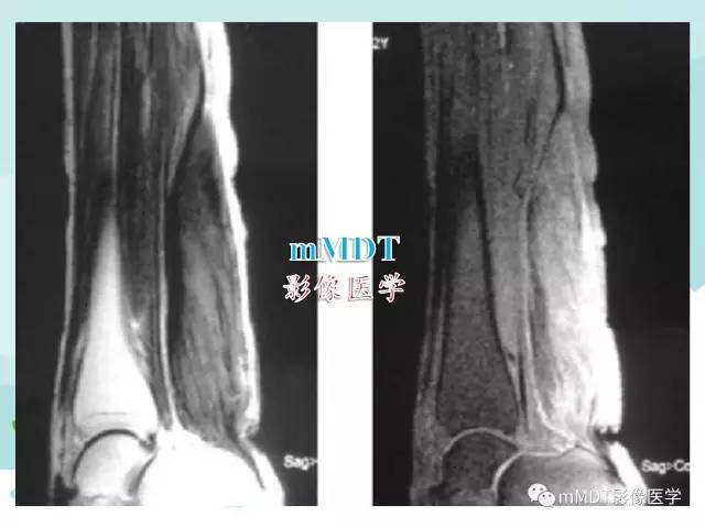 【PPT】脑腱黄瘤病