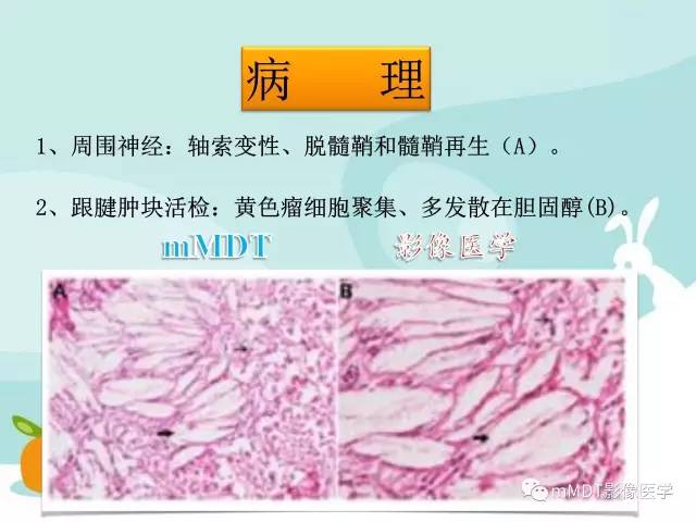 【PPT】脑腱黄瘤病