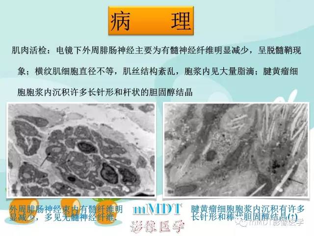 【PPT】脑腱黄瘤病