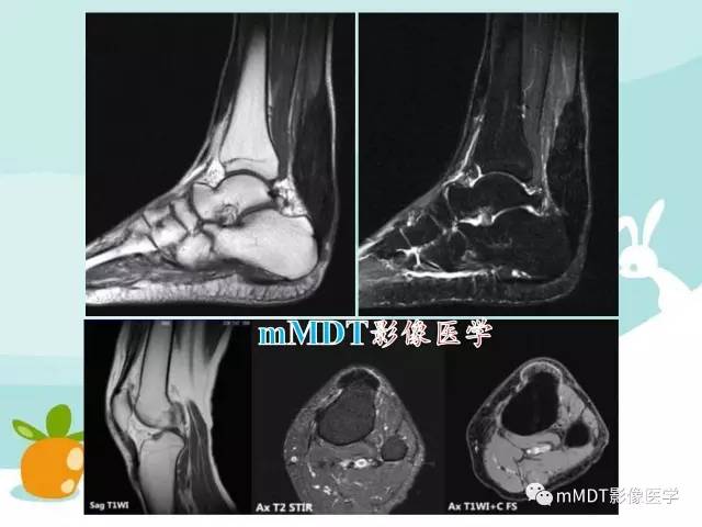 【PPT】脑腱黄瘤病