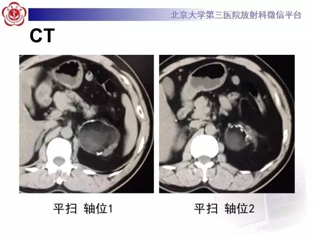 【病例】肾上腺畸胎瘤1例CT影像表现