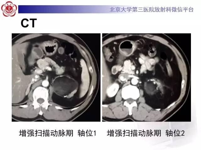 【病例】肾上腺畸胎瘤1例CT影像表现
