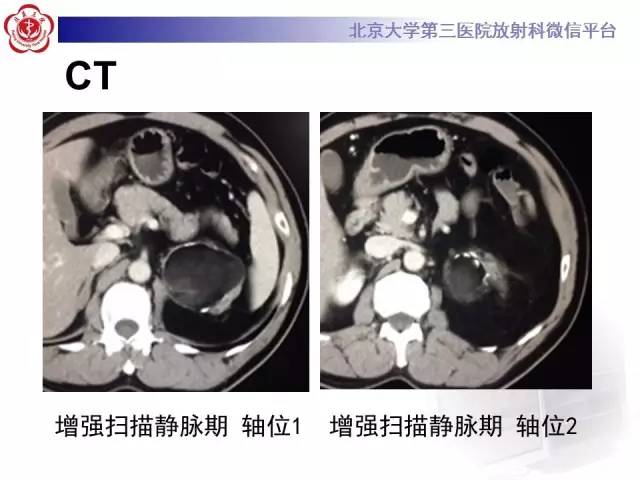 【病例】肾上腺畸胎瘤1例CT影像表现