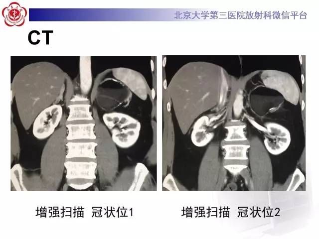 【病例】肾上腺畸胎瘤1例CT影像表现