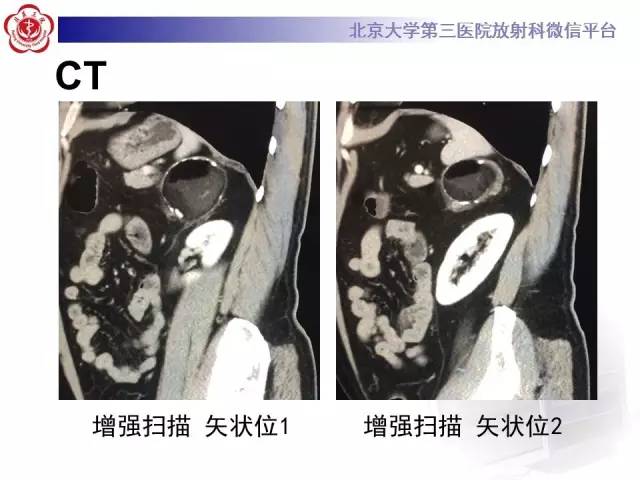 【病例】肾上腺畸胎瘤1例CT影像表现