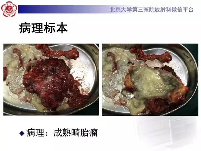 【病例】肾上腺畸胎瘤1例CT影像表现
