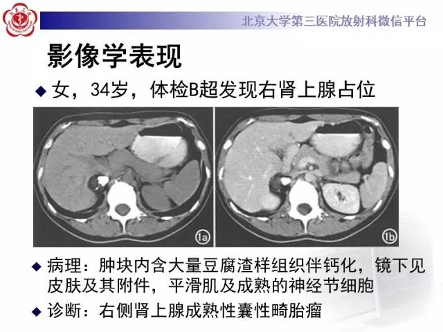 【病例】肾上腺畸胎瘤1例CT影像表现