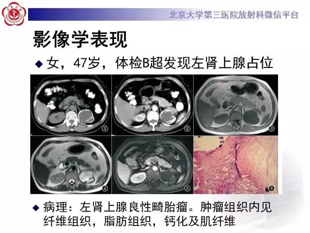【病例】肾上腺畸胎瘤1例CT影像表现