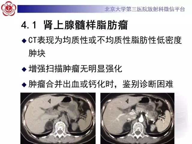 【病例】肾上腺畸胎瘤1例CT影像表现