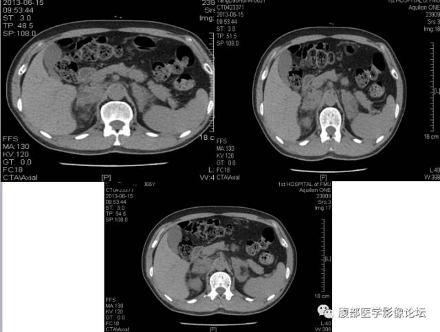 【病例】肾上腺病例6例CT 【病例】肾上腺病例6例CT