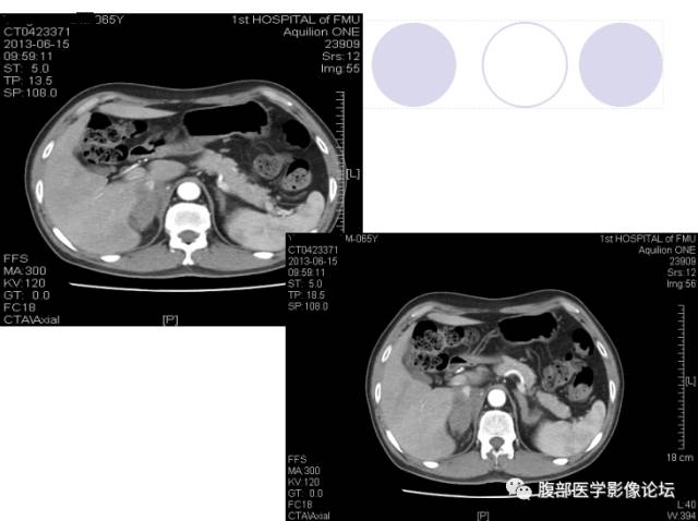 【病例】肾上腺病例6例CT 【病例】肾上腺病例6例CT