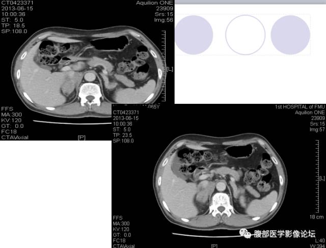 【病例】肾上腺病例6例CT 【病例】肾上腺病例6例CT
