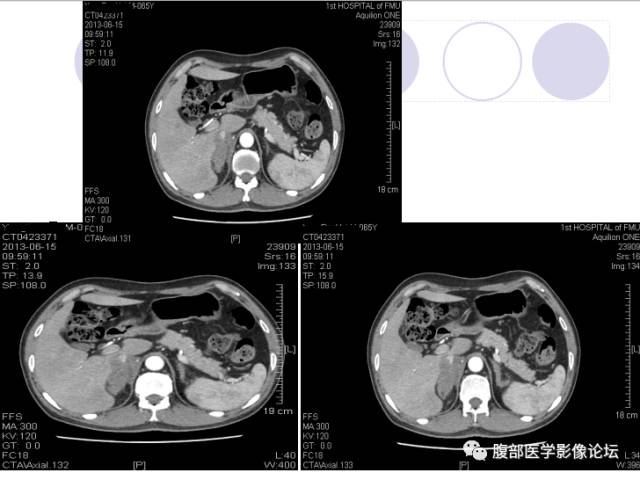 【病例】肾上腺病例6例CT 【病例】肾上腺病例6例CT