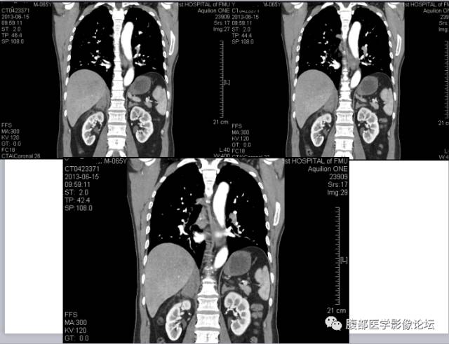 【病例】肾上腺病例6例CT 【病例】肾上腺病例6例CT