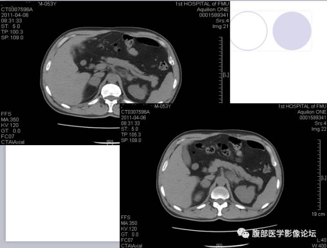 【病例】肾上腺病例6例CT 【病例】肾上腺病例6例CT