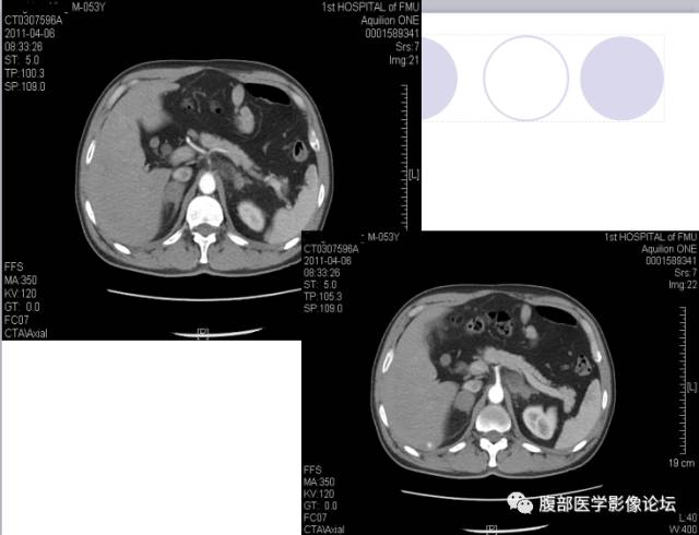 【病例】肾上腺病例6例CT 【病例】肾上腺病例6例CT