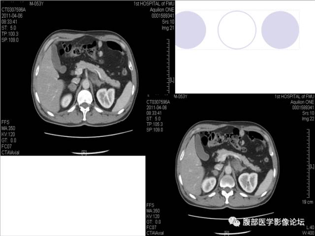 【病例】肾上腺病例6例CT 【病例】肾上腺病例6例CT