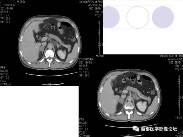 【病例】肾上腺病例6例CT 【病例】肾上腺病例6例CT