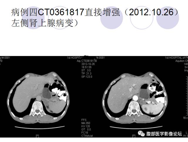 【病例】肾上腺病例6例CT 【病例】肾上腺病例6例CT