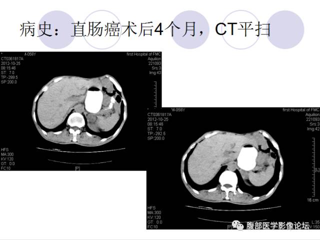 【病例】肾上腺病例6例CT 【病例】肾上腺病例6例CT