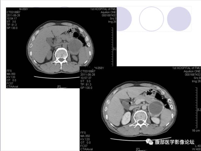 【病例】肾上腺病例6例CT 【病例】肾上腺病例6例CT