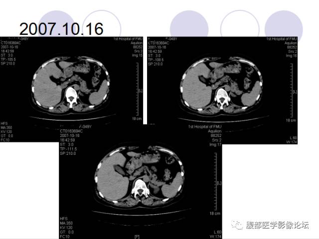 【病例】肾上腺病例6例CT 【病例】肾上腺病例6例CT