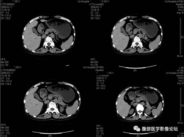 【病例】肾上腺病例6例CT 【病例】肾上腺病例6例CT